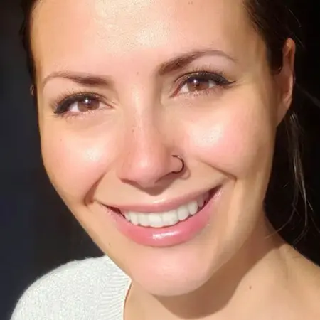 After — Invisalign